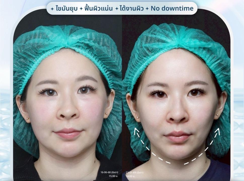 ก่อนทำ